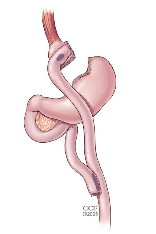 Gastric Bypass